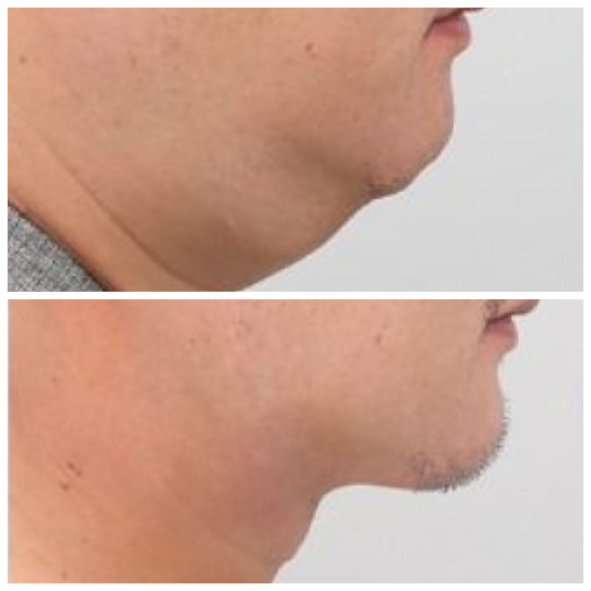 Результаты липосакции подбородка до и после в AB Plastic Surgery – улучшенный контур челюсти