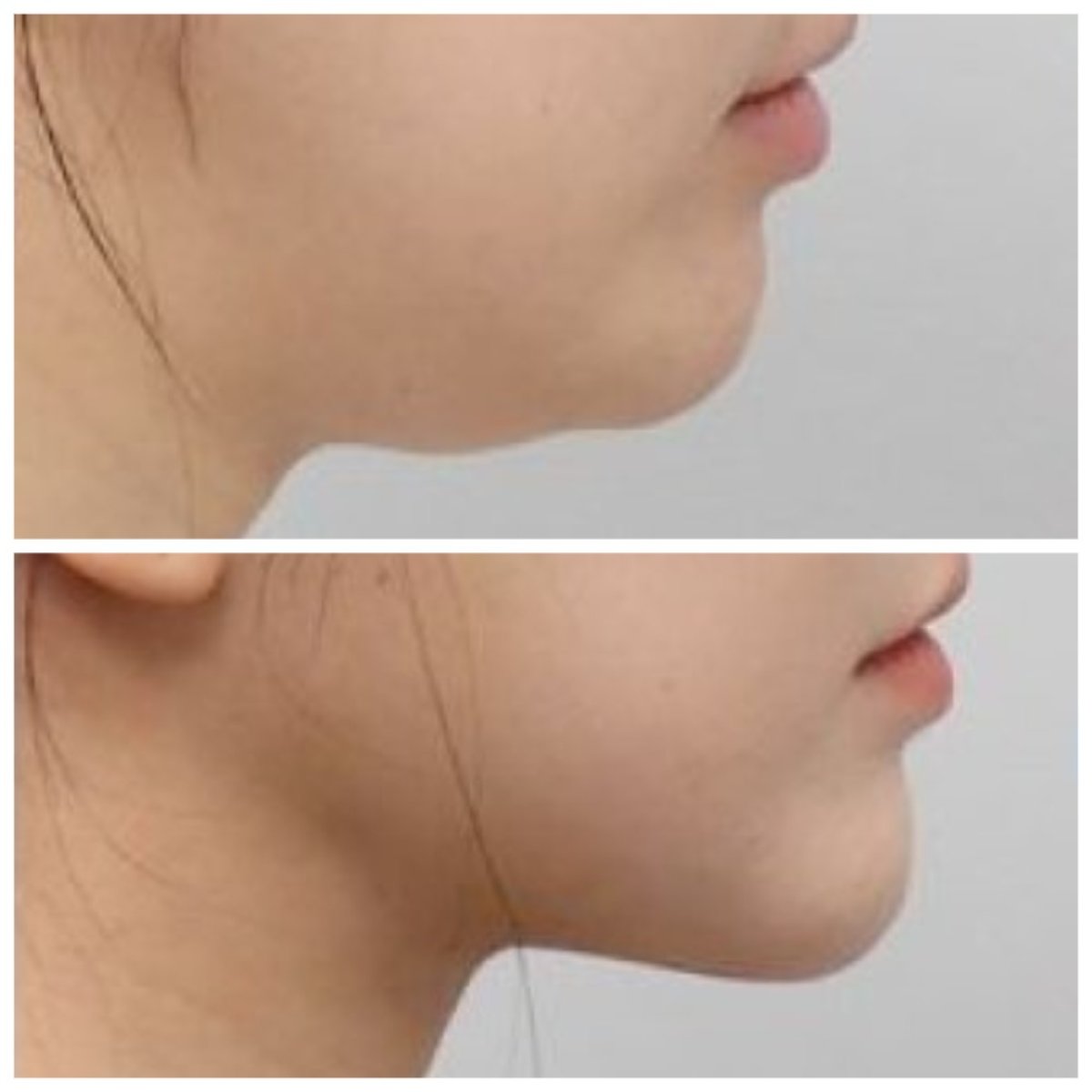 Before and after chin liposuction results at AB Plastic Surgery – improved jawline contour