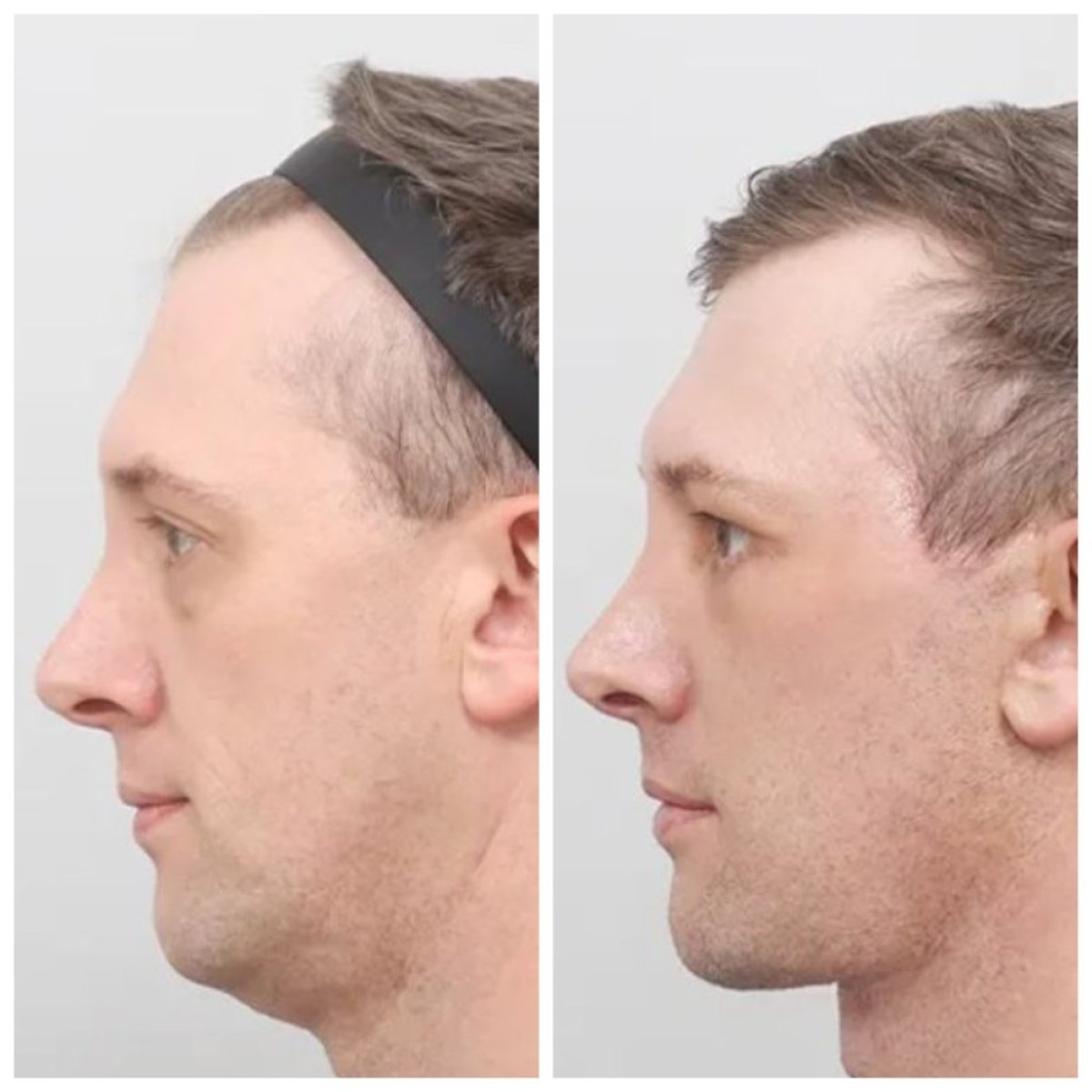Résultats avant/après liposuccion du menton chez AB Plastic Surgery – contour amélioré