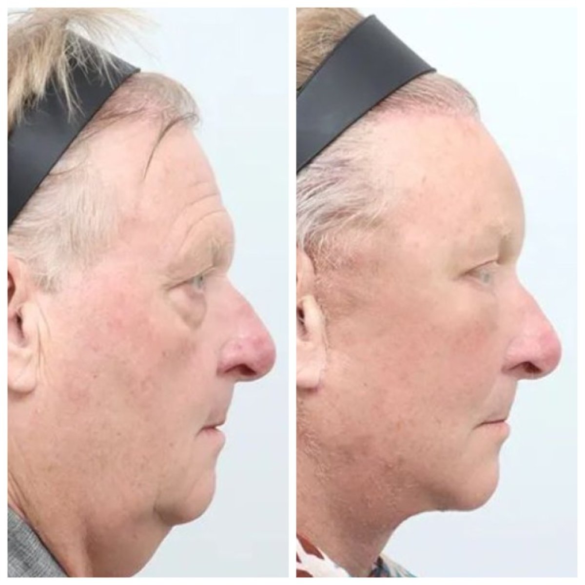نتيجة شفط دهون الذقن قبل وبعد في AB Plastic Surgery، تحسين تحديد الفك