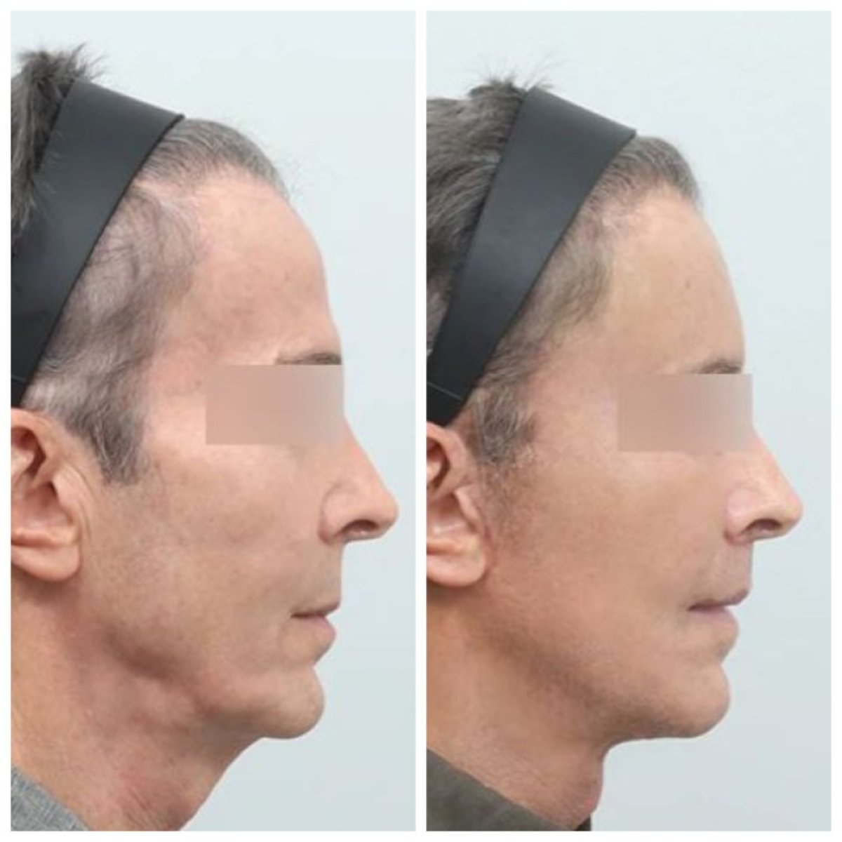 نتيجة شفط دهون الذقن قبل وبعد في AB Plastic Surgery – تحسين تحديد الفك