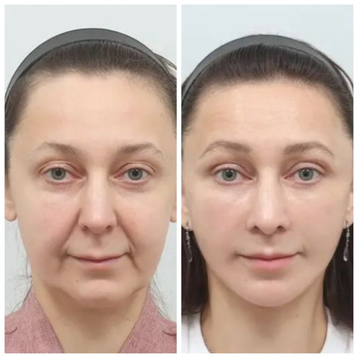 Facelift before and after results at AB Plastic Surgery – visible facial rejuvenation outcome