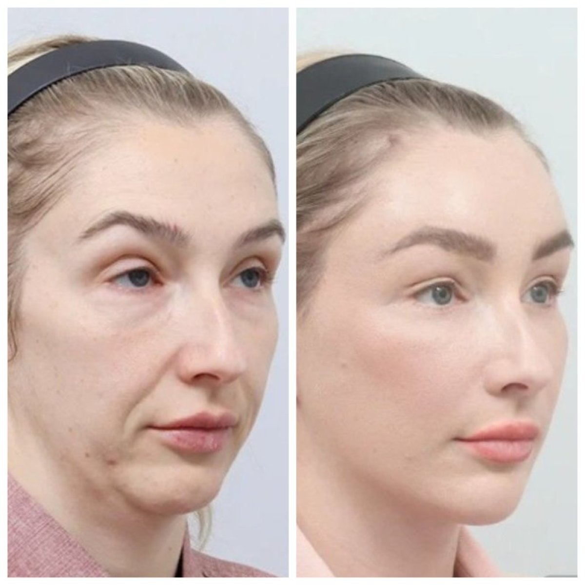 Результаты до и после SMAS-лифтинга в AB Plastic Surgery – омоложение и подтяжка лица