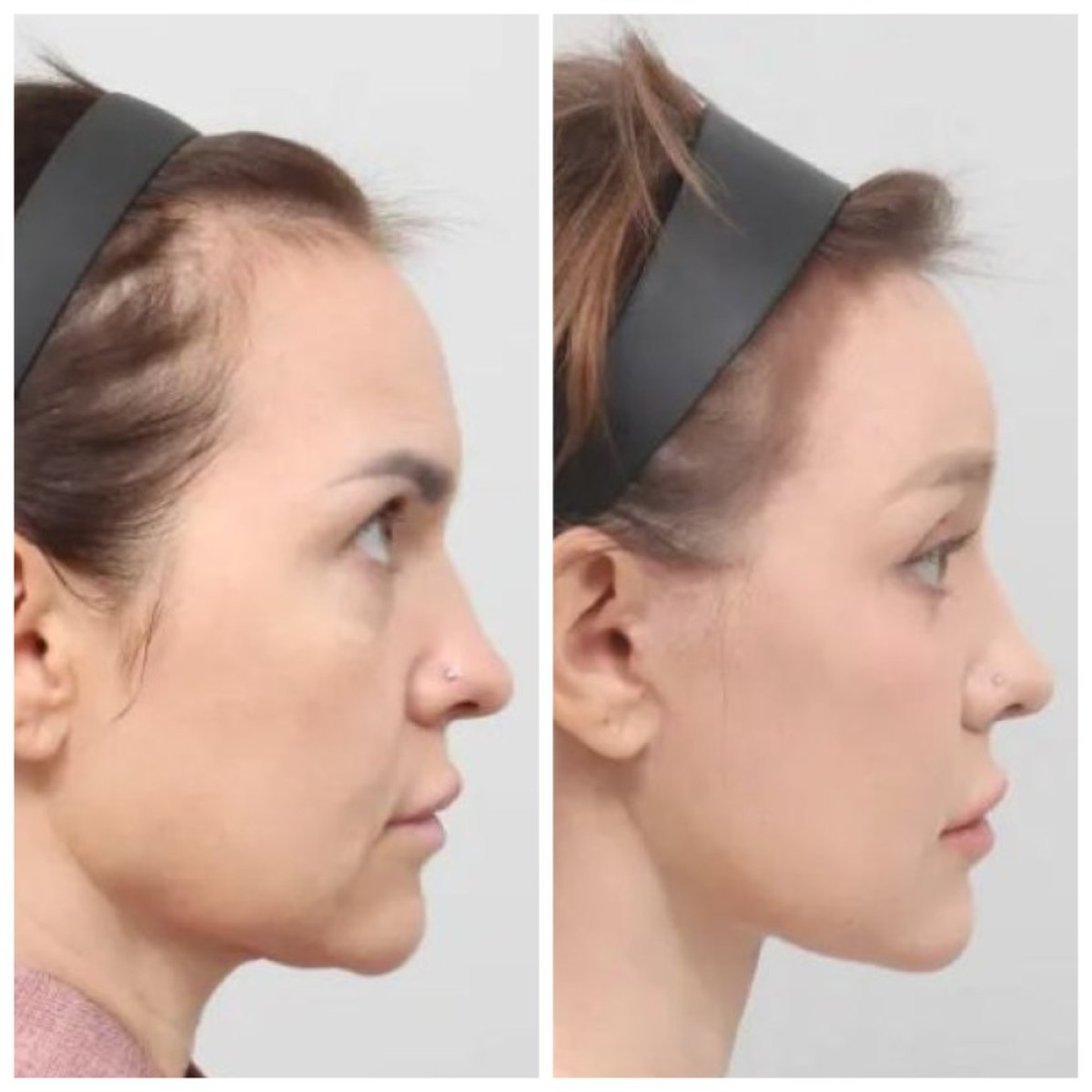 Before and after facelift results at AB Plastic Surgery – visible facial rejuvenation outcome