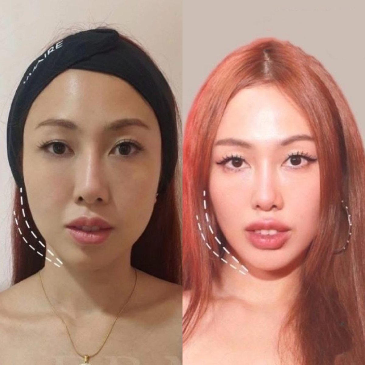 Resultados de botox para afinamiento de mandíbula antes y después en Nicha Clinic Pattaya