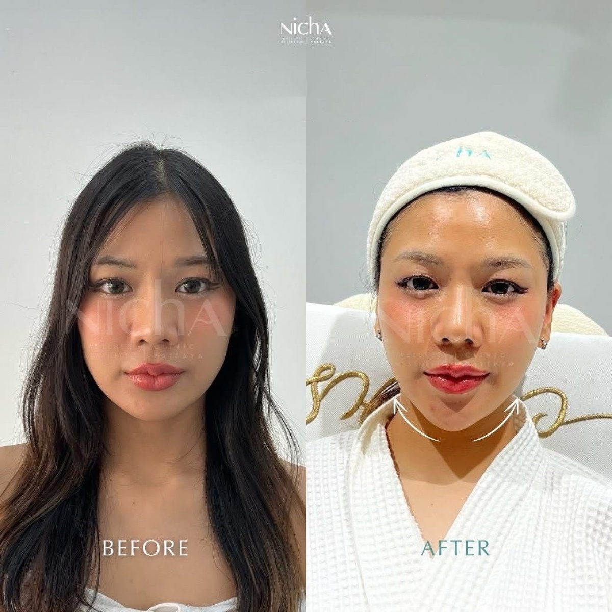 Resultados antes y después de botox en Nicha Clinic Pattaya- Aesthetic & Wellness, afinamiento facial