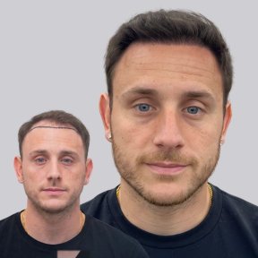 Premium Hair Transplant Package - photo 5