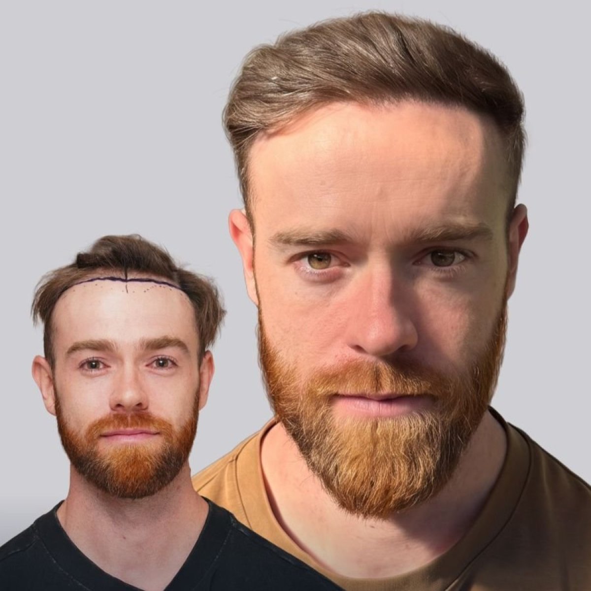 Before and after hair transplant results in male patient – restored hairline and fuller hair