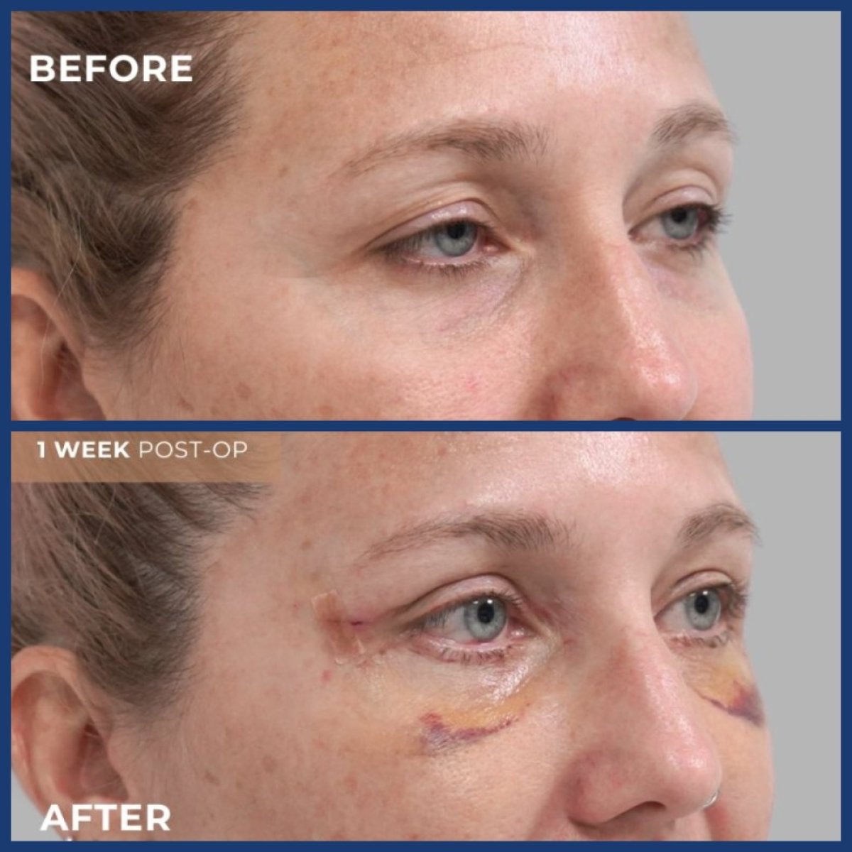 Vorher-nachher-Ergebnis der Blepharoplastik in Hospital Cyntar Tijuana, sichtbare Korrektur