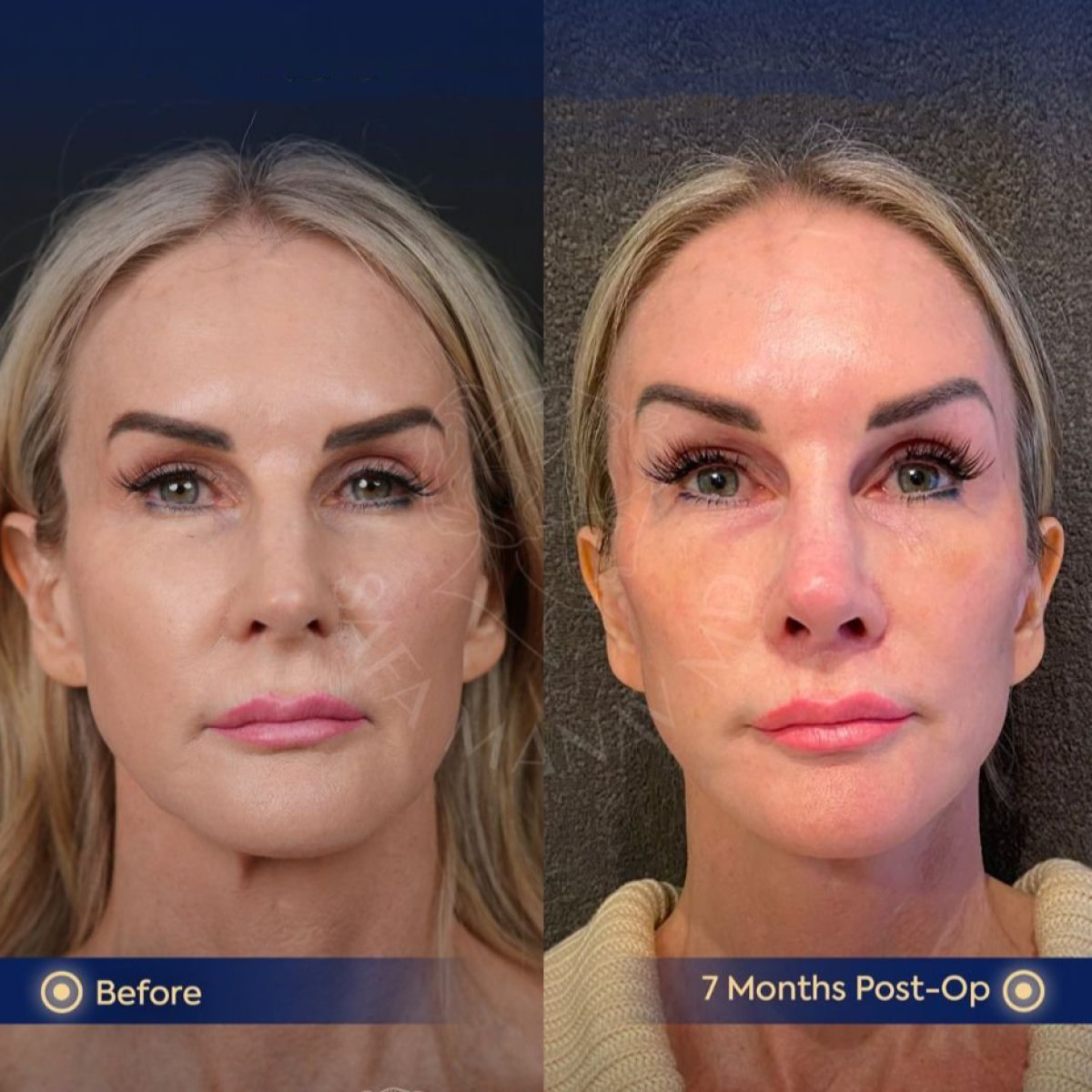 Resultados de transferencia de grasa facial antes y después en Dr. Safa Manav Clinic, 7 meses