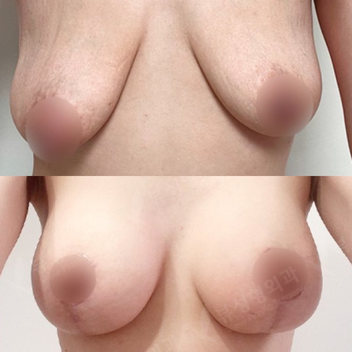 Vorher-nachher Brustimplantate mit Straffung bei View Plastic Surgery Hospital, verbessertes Ergebnis