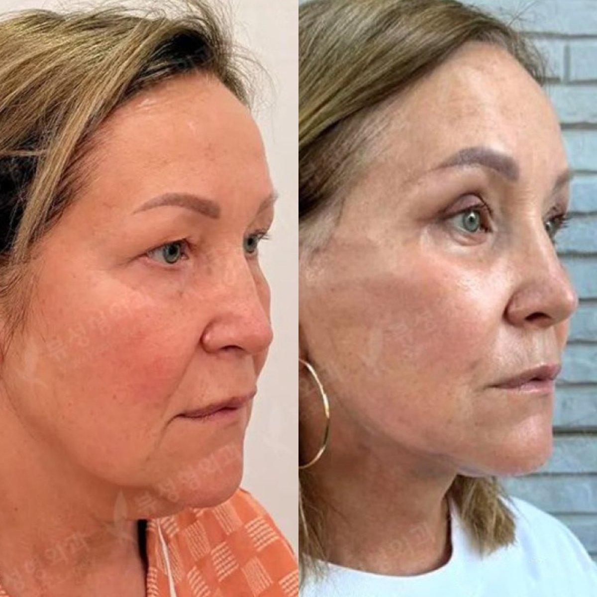 نتائج شد الجفن السفلي قبل وبعد في مستشفى View Plastic Surgery Hospital