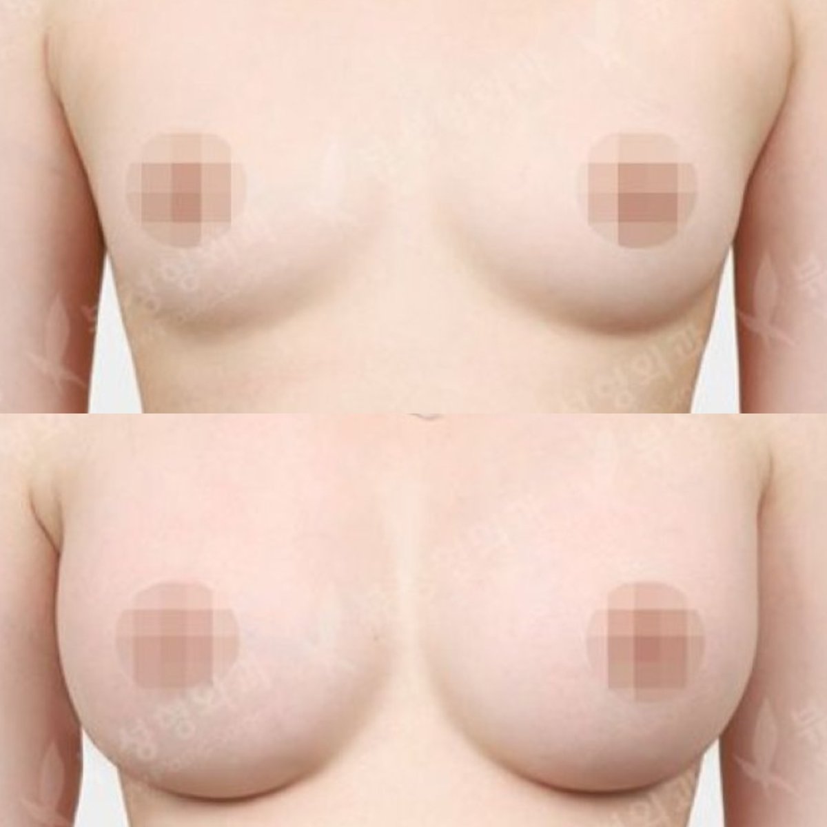 Before and after breast augmentation results at View Plastic Surgery Hospital, fuller breasts