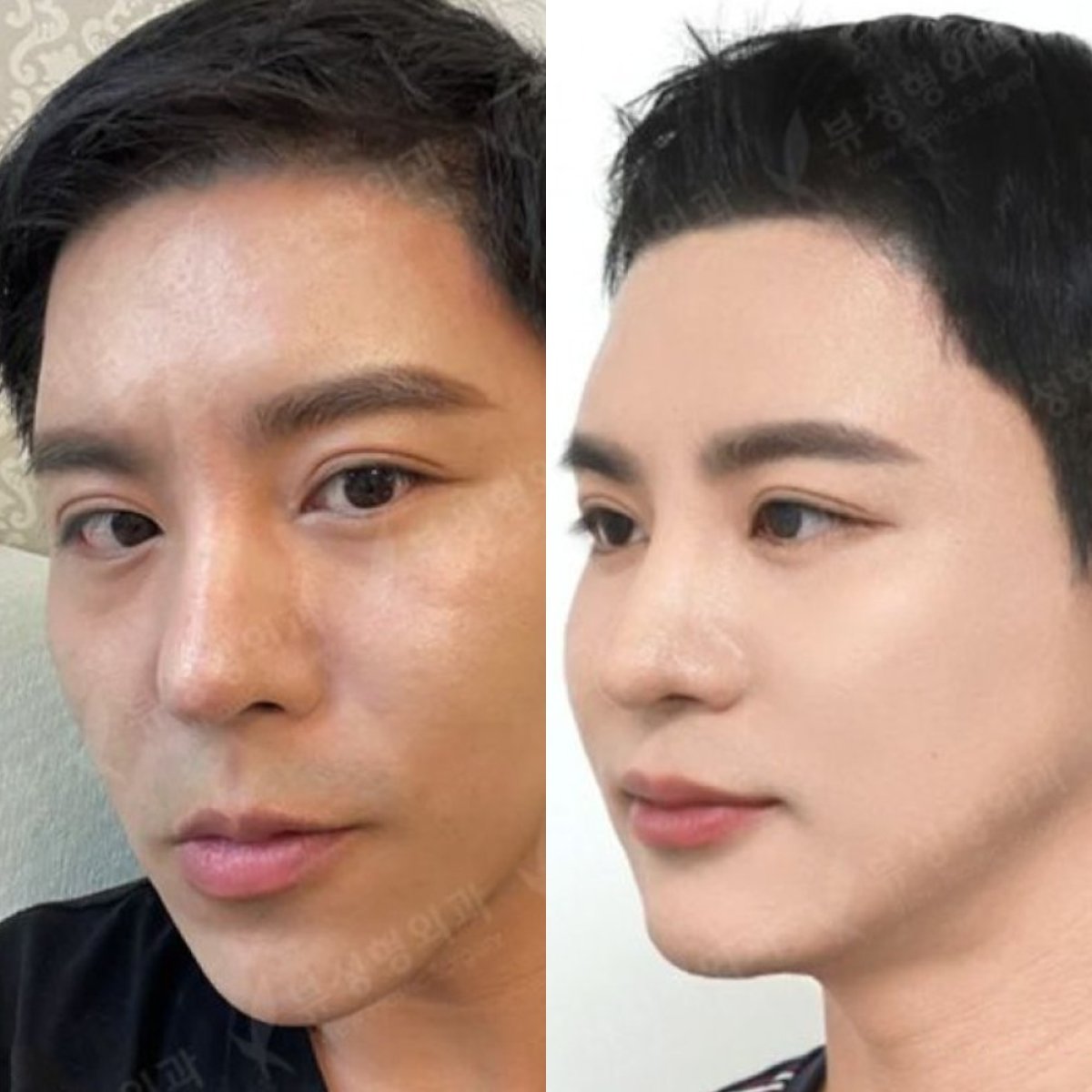نتائج قبل وبعد جراحة الفكين في مستشفى View Plastic Surgery، تحديد ملامح الوجه