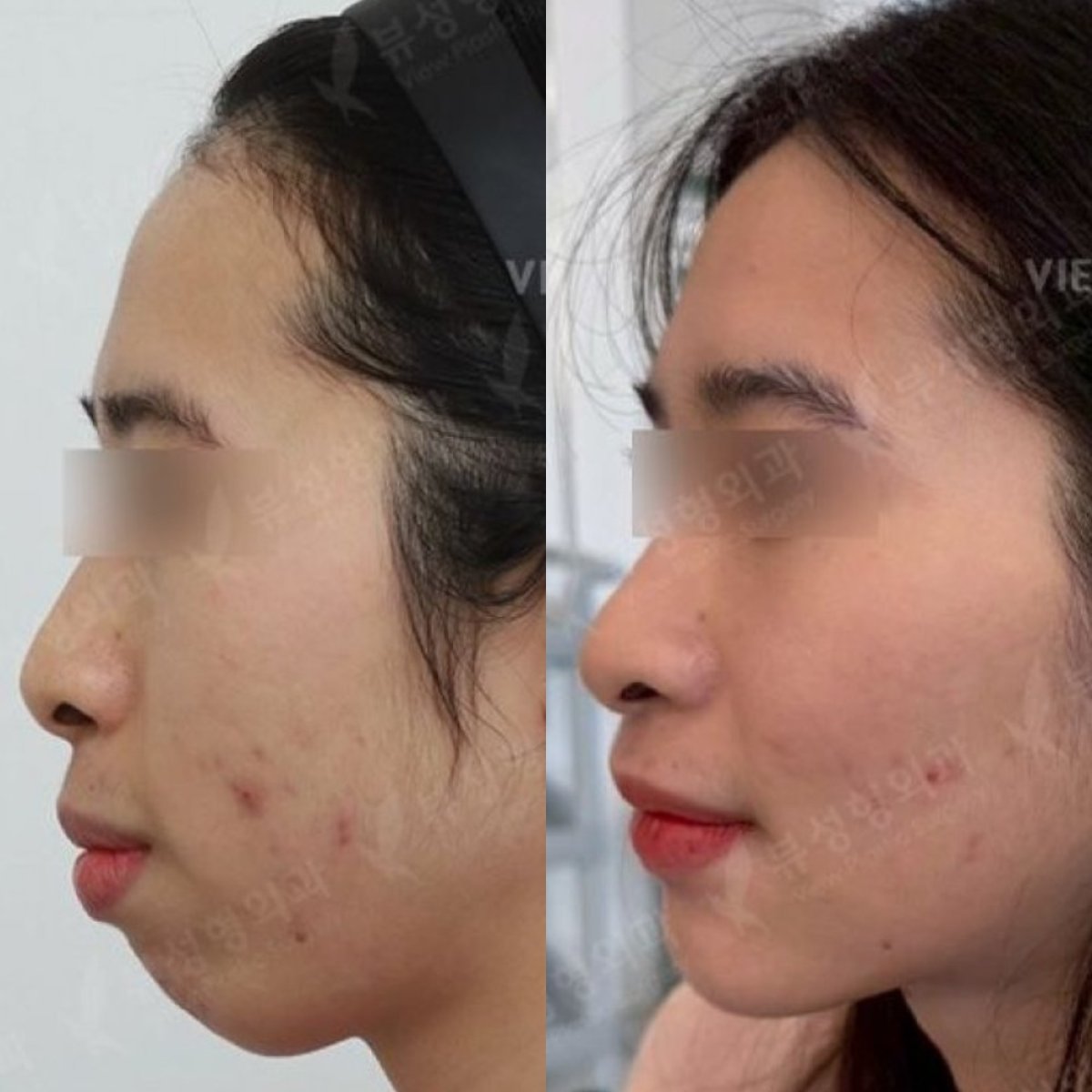Результат до и после ортогнатической хирургии в View Plastic Surgery Hospital, коррекция челюсти