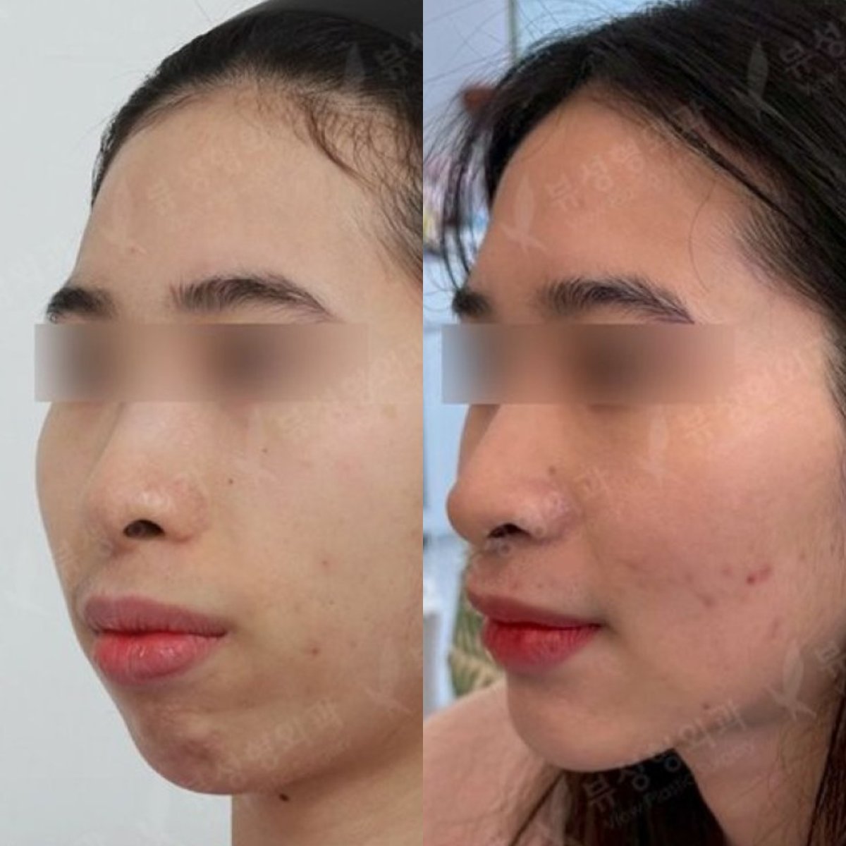 نتائج قبل وبعد جراحة الفكين في مستشفى View Plastic Surgery Hospital، تحسين مظهر الوجه