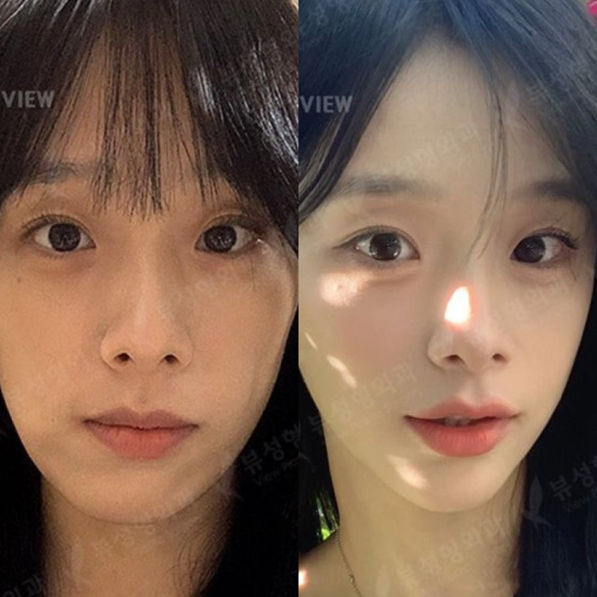 نتائج قبل وبعد جراحة الفكين في مستشفى View Plastic Surgery، تحسين ملامح الوجه