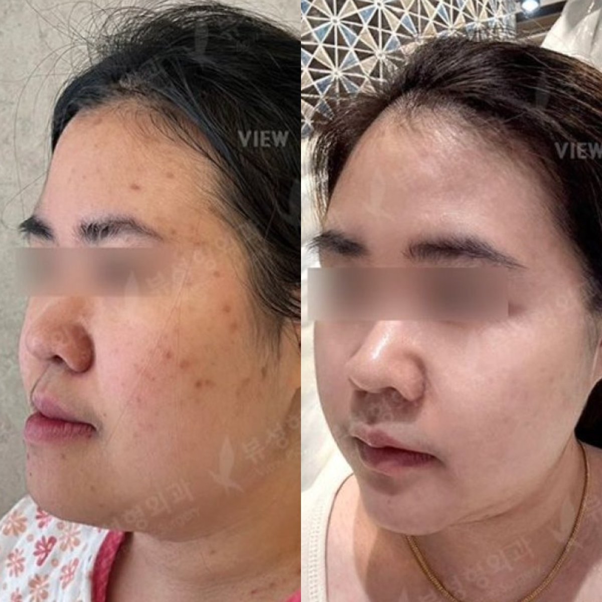 قبل وبعد جراحة الفكين في View Plastic Surgery Hospital، نتائج تحديد ملامح الوجه