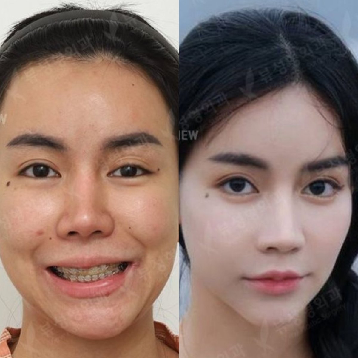 نتائج قبل وبعد جراحة الفكين في مستشفى View Plastic Surgery، تغيير ملامح الوجه