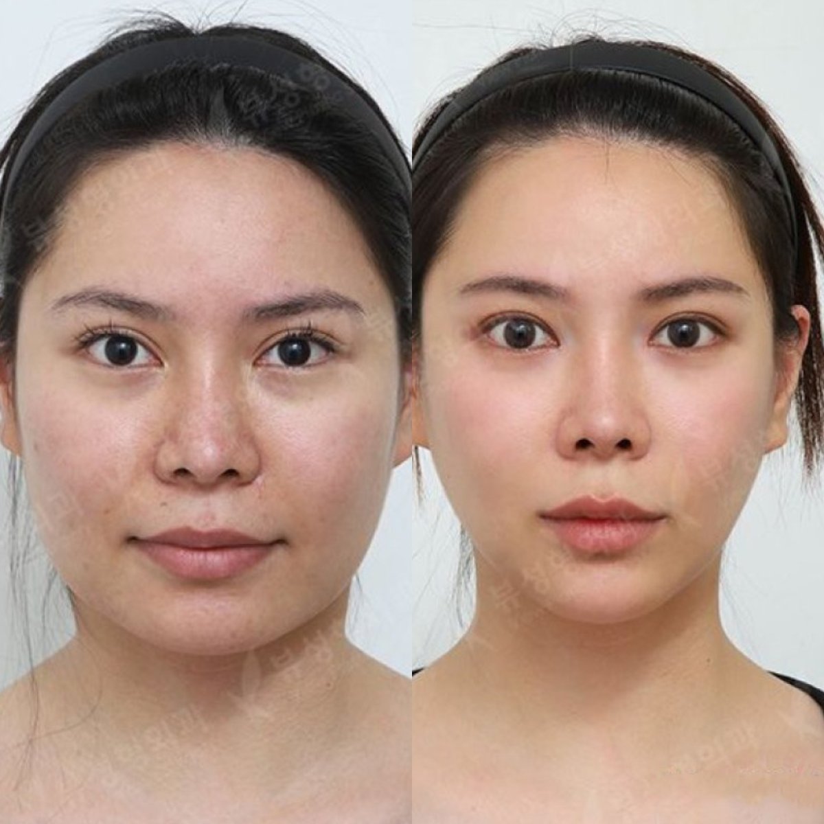 Before and after chin implant results at View Plastic Surgery Hospital, enhanced chin contour