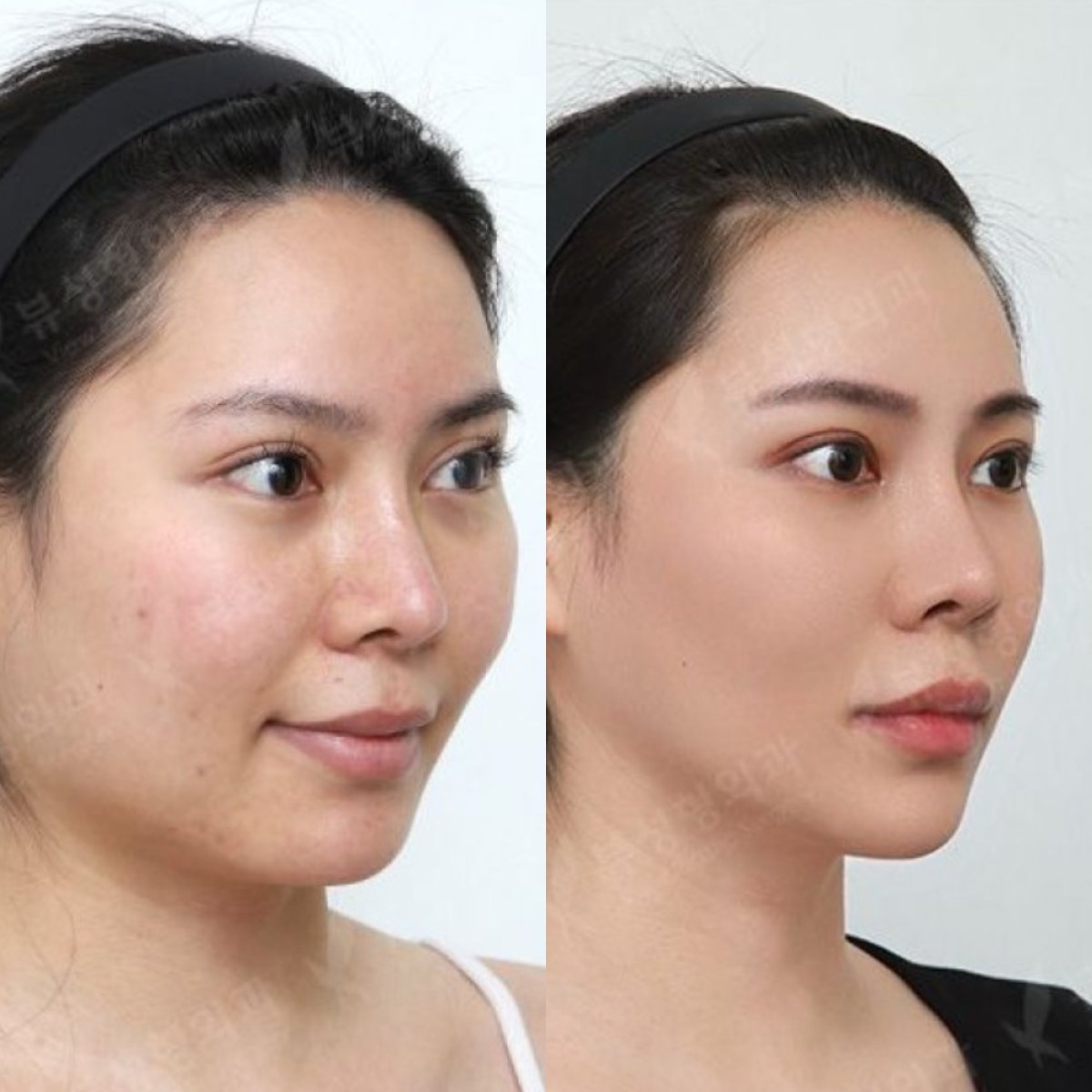 Before and after chin implant results at View Plastic Surgery Hospital, enhanced chin contour