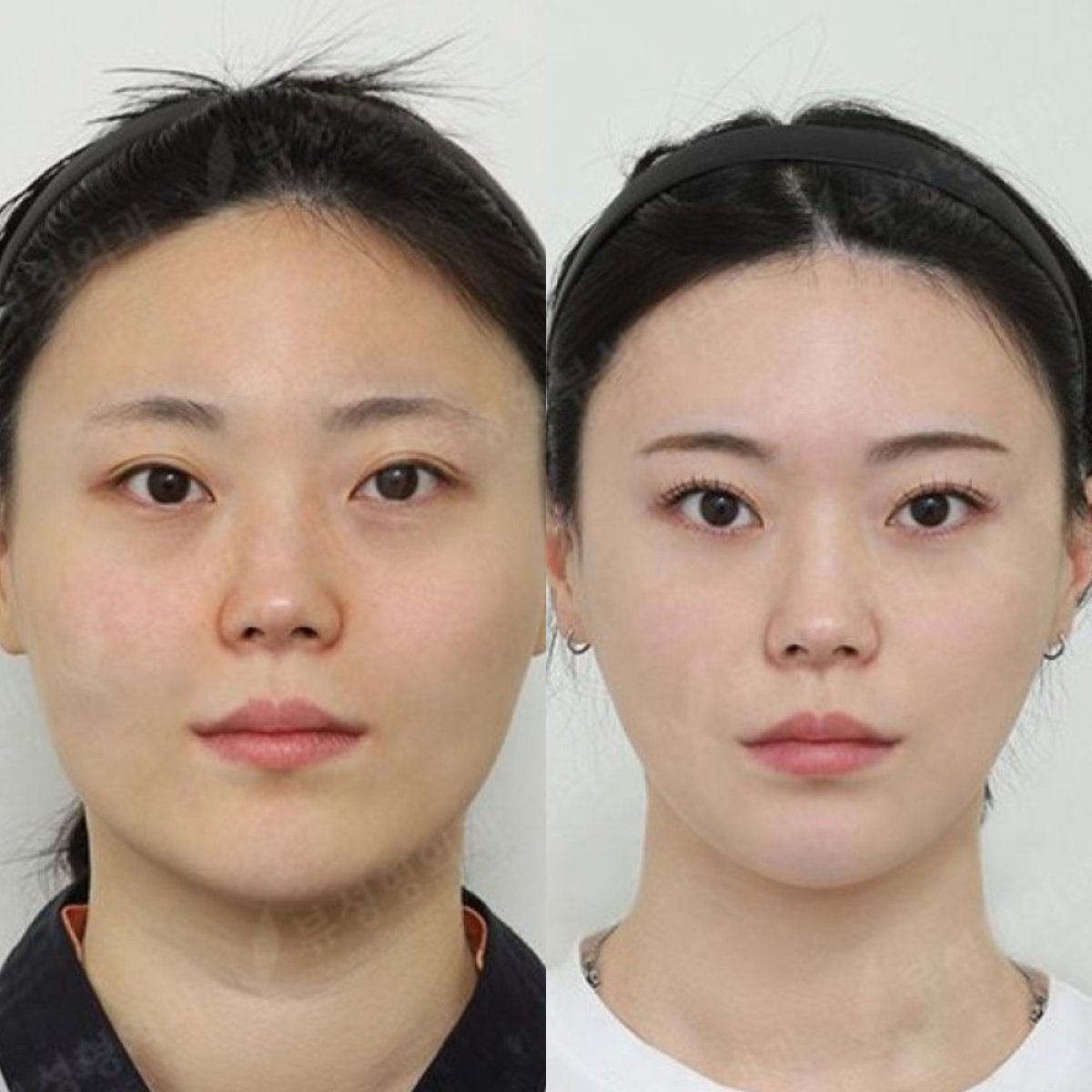 Before and after chin implant results at View Plastic Surgery Hospital, enhanced chin contour