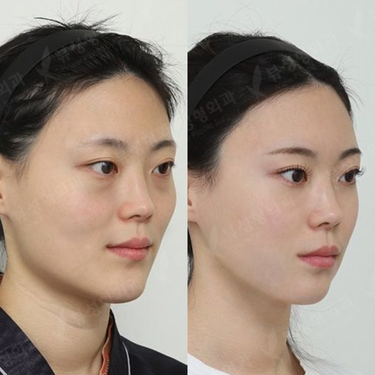Результати до та після імплантації підборіддя у View Plastic Surgery Hospital, покращений контур