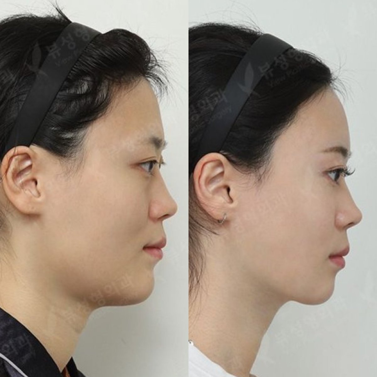نتائج قبل وبعد زراعة الذقن في مستشفى View Plastic Surgery، تحسين مظهر الذقن