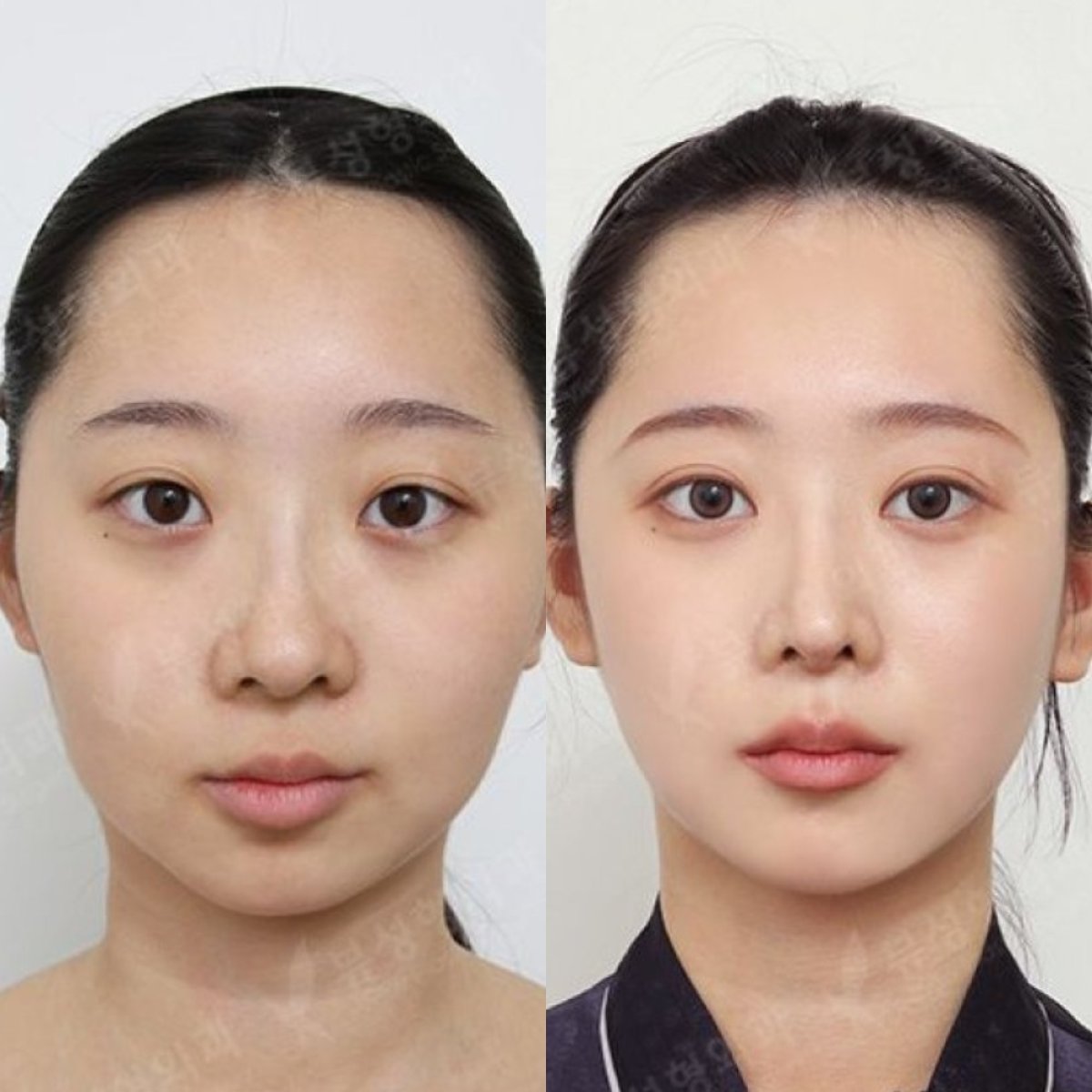 Результаты до и после имплантации подбородка в View Plastic Surgery Hospital, улучшенный контур