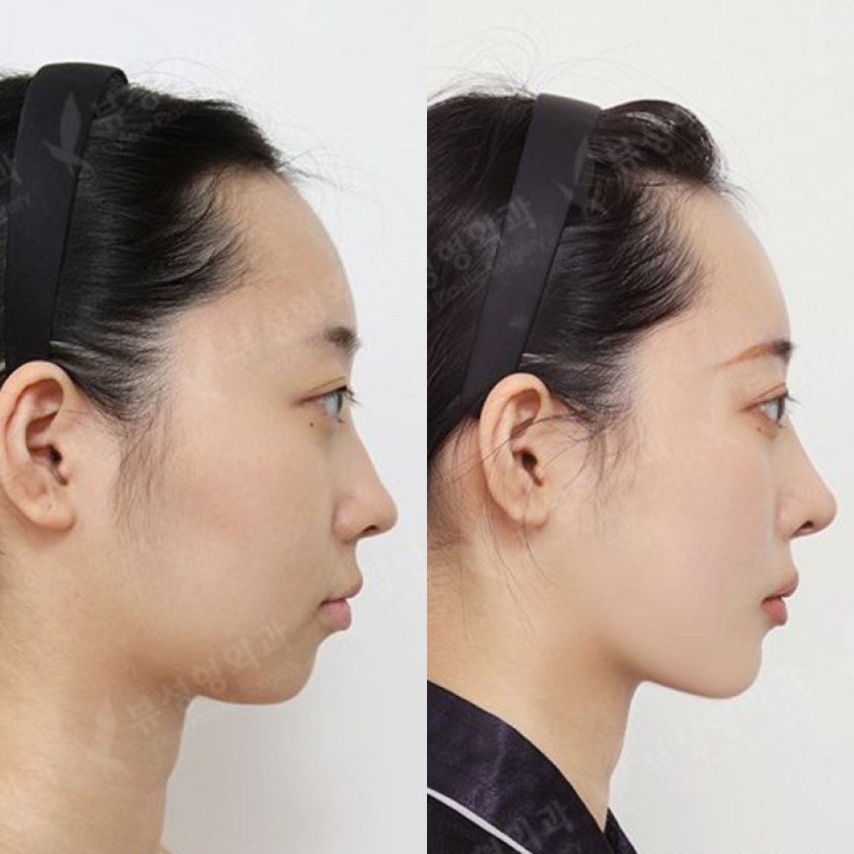 Результаты до и после имплантации подбородка в View Plastic Surgery Hospital, улучшенный профиль