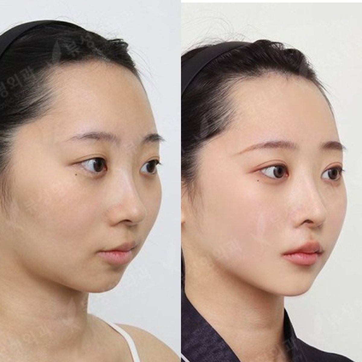 Before and after chin implant results at View Plastic Surgery Hospital, enhanced chin contour