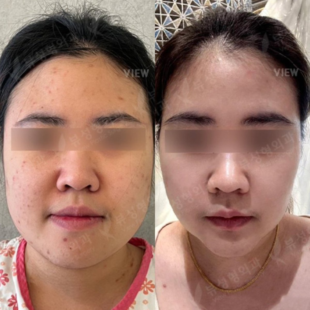 نتيجة قبل وبعد جراحة الفكين في مستشفى فيو لجراحة التجميل، تحديد ملامح الوجه