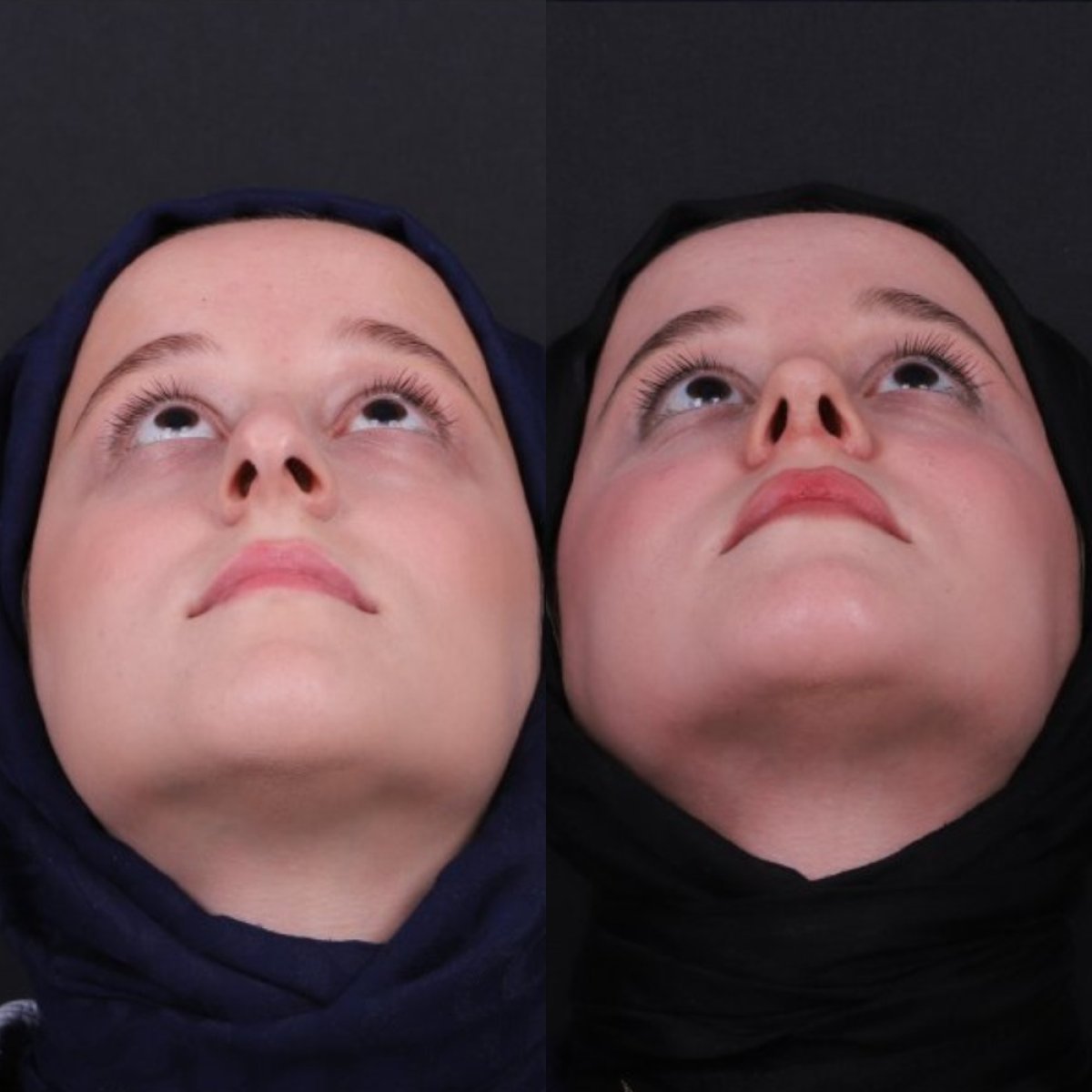 نتائج عملية تجميل الأنف قبل وبعد، تحسين شكل وتناسق الأنف لدى المريضة