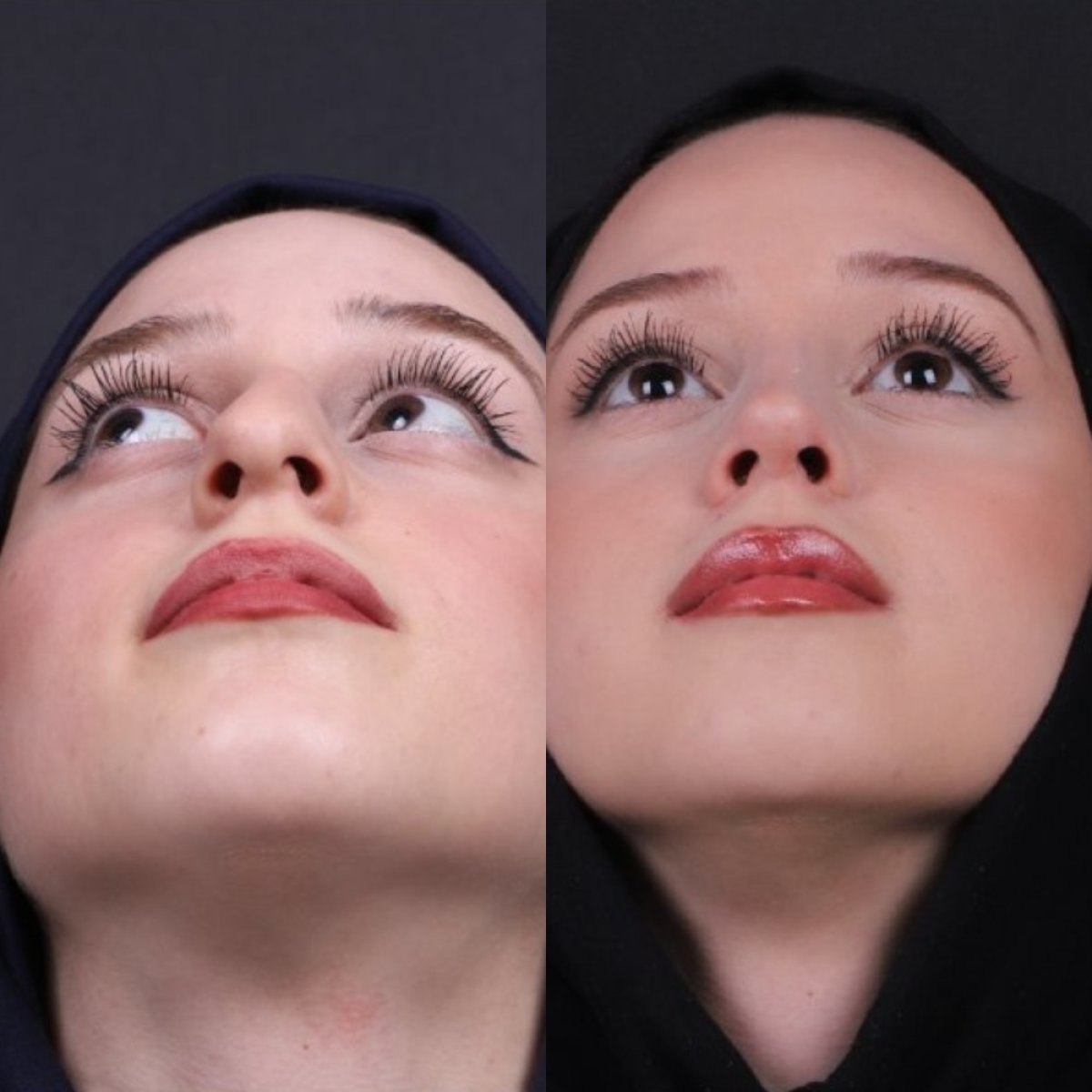 Resultados de rinoplastia antes y después, remodelación nasal y simetría mejorada