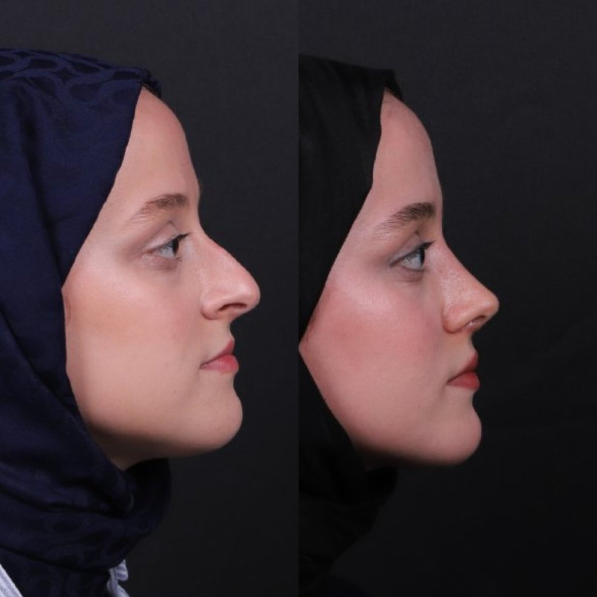 نتائج عملية تجميل الأنف قبل وبعد، إعادة تشكيل الأنف لتحسين المظهر والتناظر