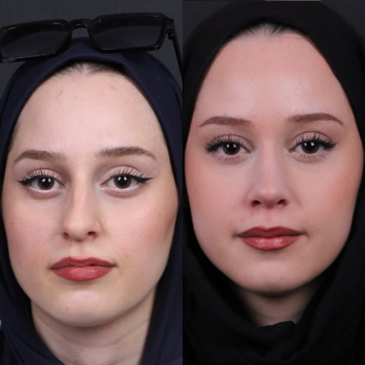 نتائج تجميل الأنف قبل وبعد، تحسين شكل وتناسق الأنف لمريضة