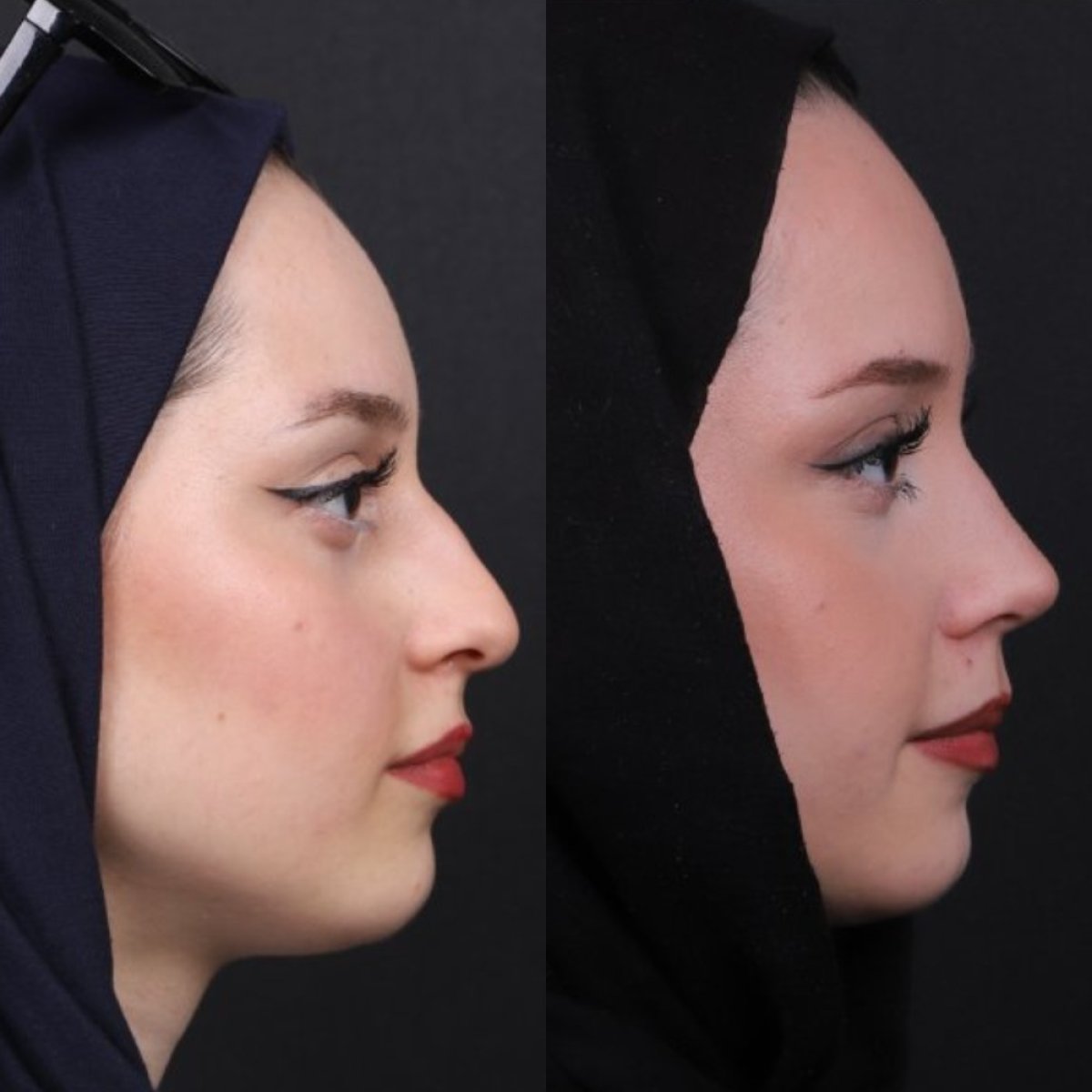 نتائج عملية تجميل الأنف قبل وبعد، تحسين طبيعي لشكل الأنف الجانبي