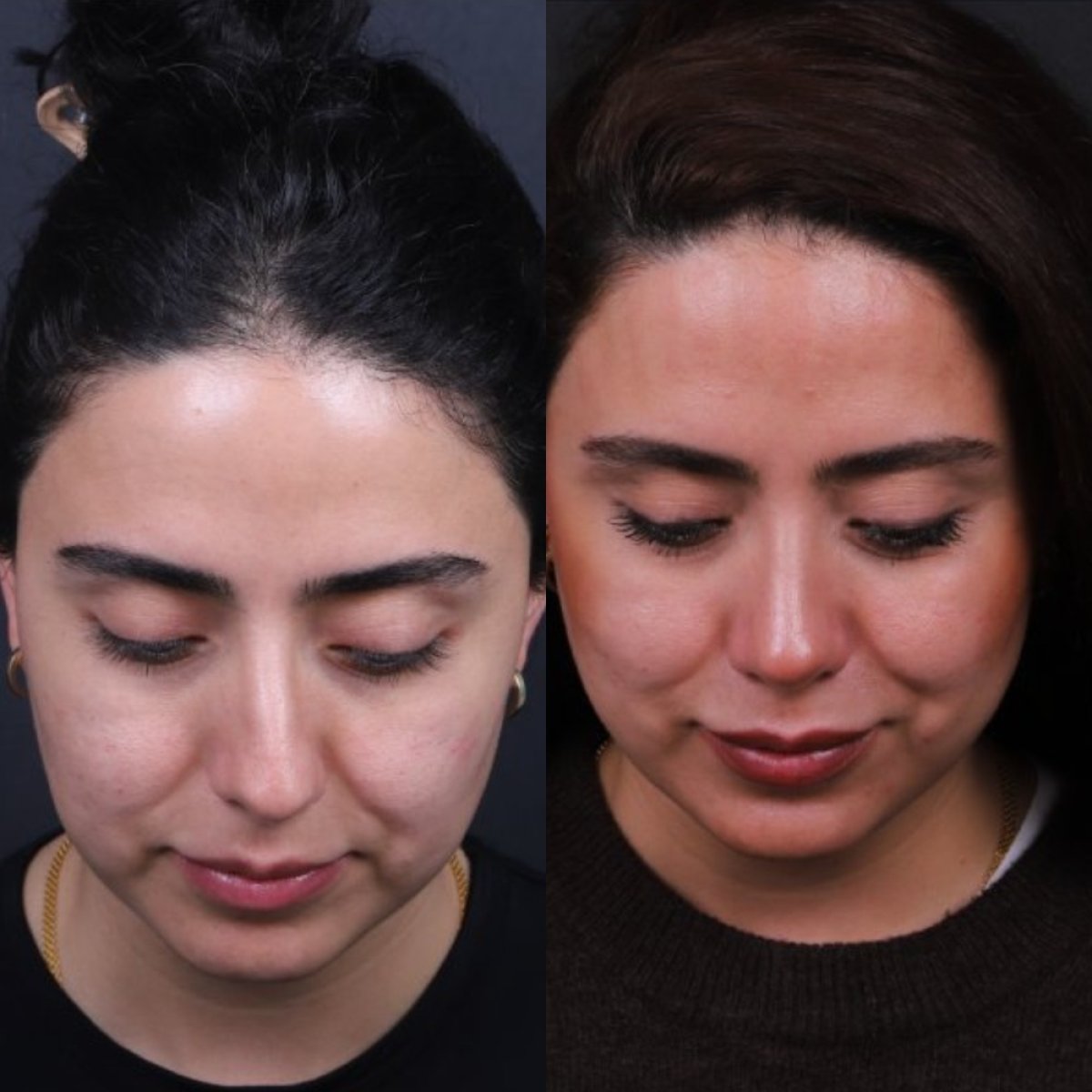 نتائج عملية تجميل الأنف قبل وبعد، تحسين طبيعي لشكل الأنف
