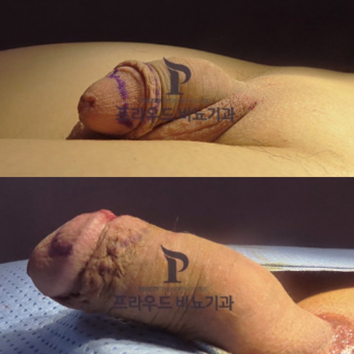 نتائج تكبير القضيب قبل وبعد في Proud Urology Clinic، زيادة ملحوظة بالحجم