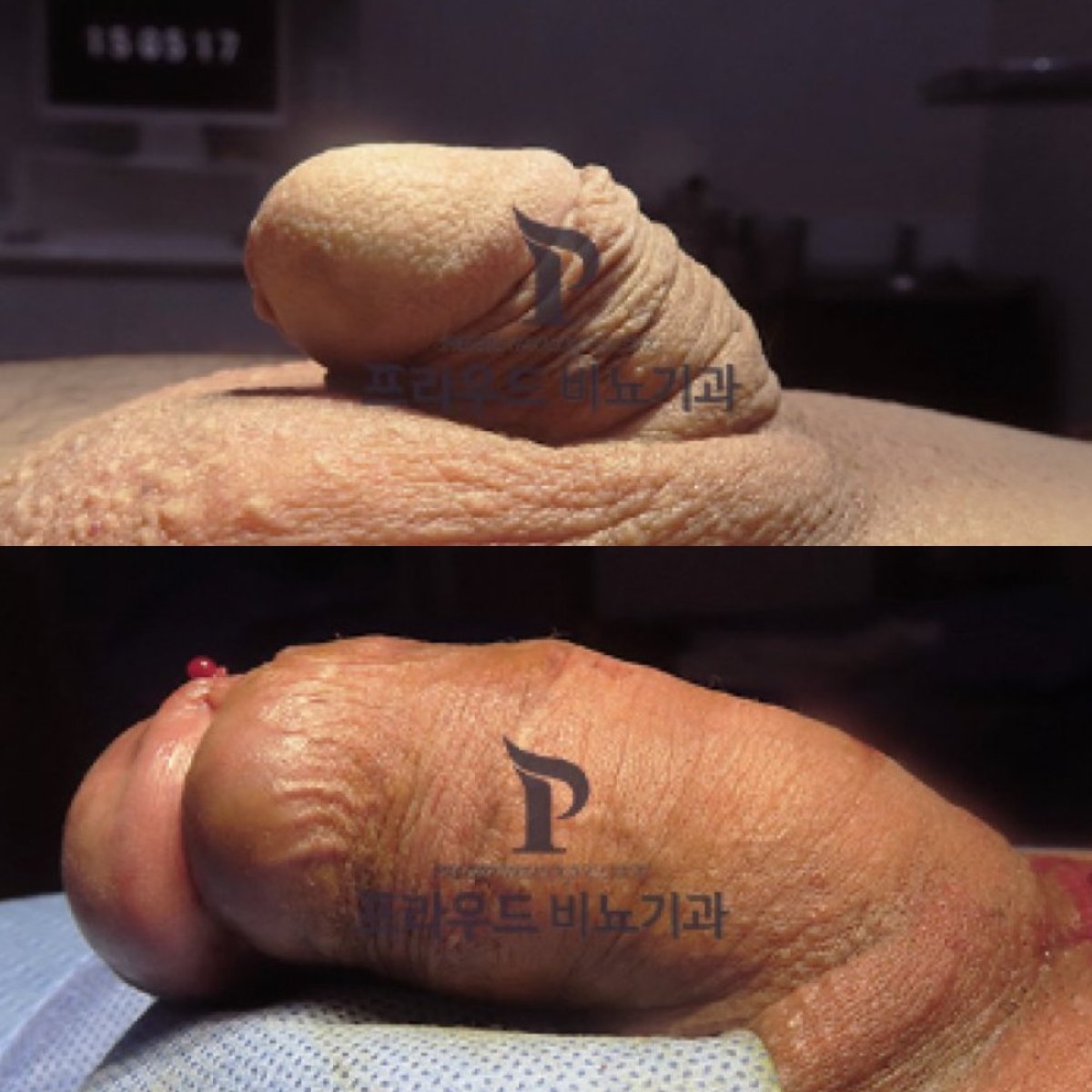 Before and after penis enlargement results at clinic, visible increase in girth and size