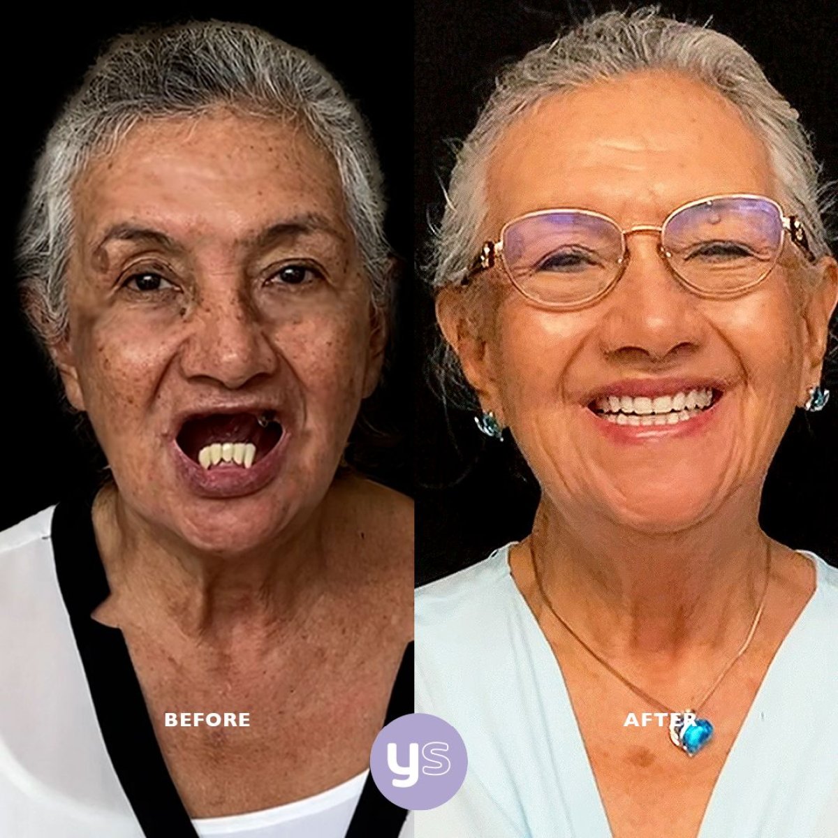 Before and after Zygomatic All-on-4 implants result at YeahSmile – full smile restoration