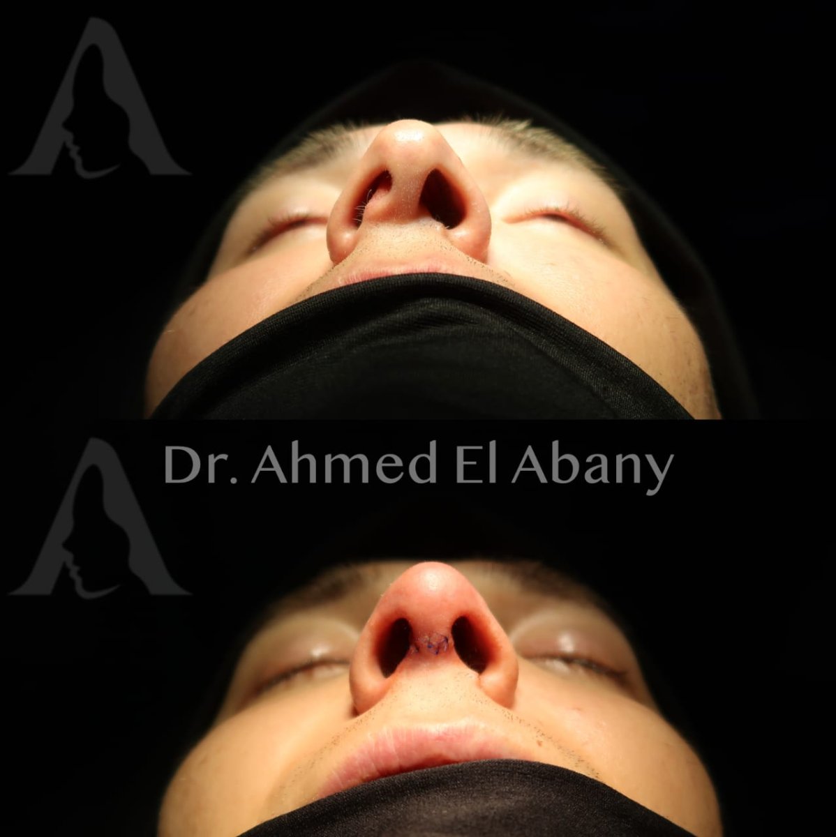 نتائج عملية تجميل الأنف قبل وبعد في PyraMedicine، تحسين شكل وتناسق الأنف