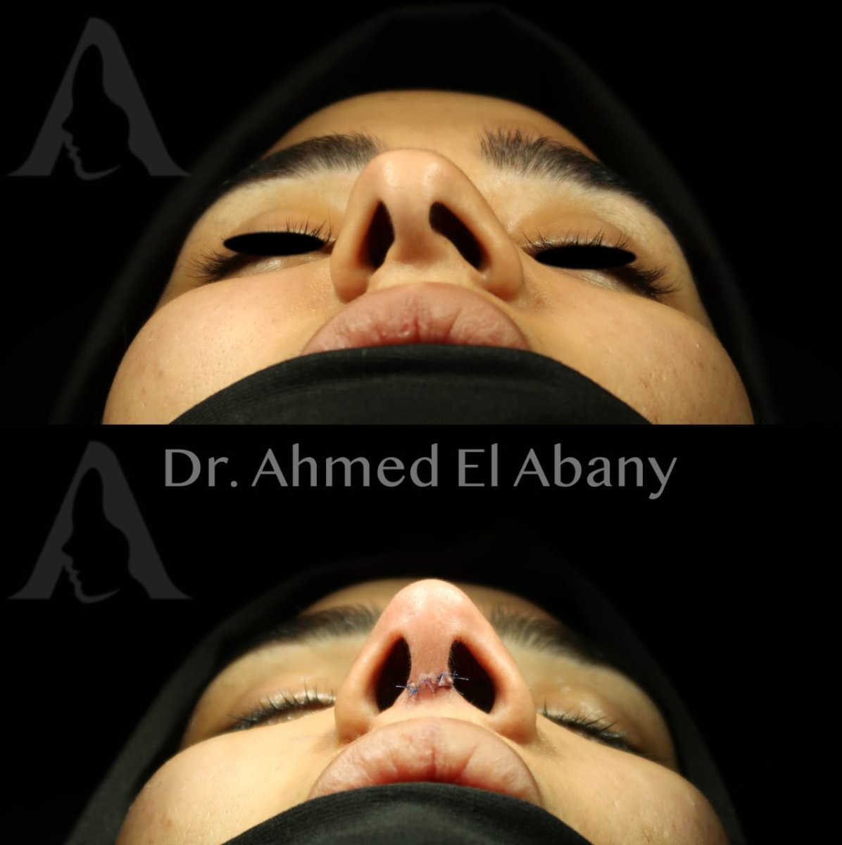 نتائج تجميل الأنف قبل وبعد في PyraMedicine، تحسين شكل الأنف وتناسقه