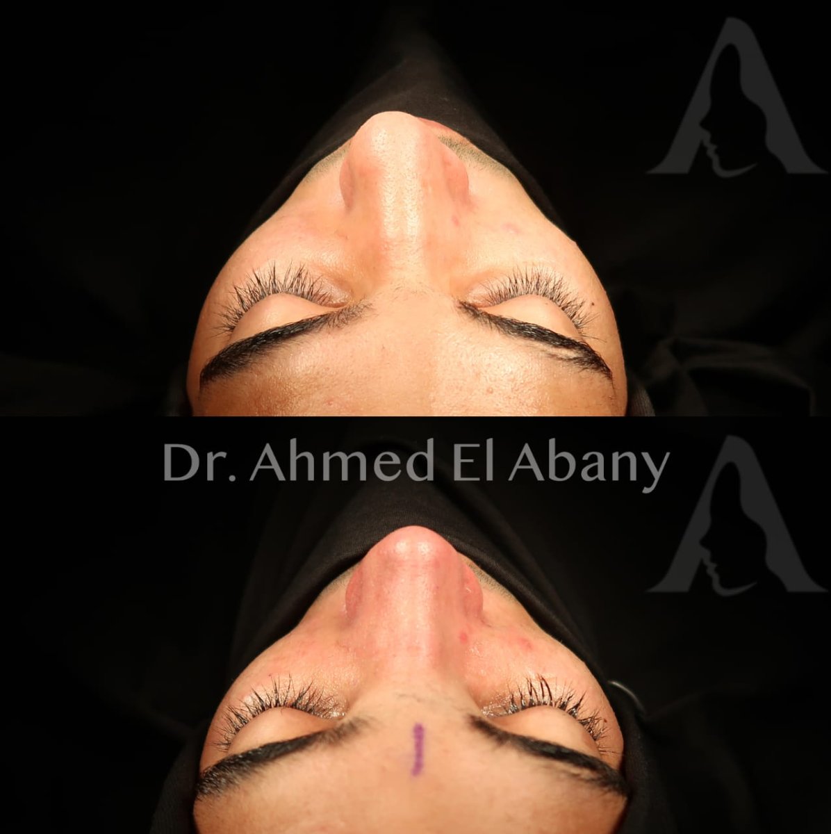 نتائج عملية تجميل الأنف قبل وبعد في PyraMedicine، إعادة تشكيل الأنف بشكل طبيعي
