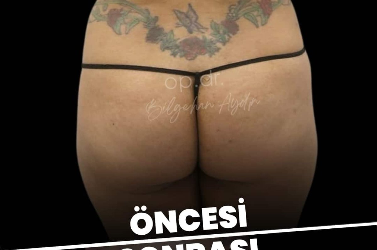 Brazilian Butt Lift before and after result, enhanced buttock contour at clinic