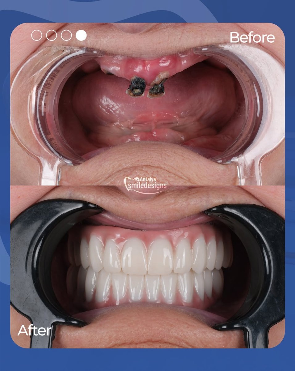 Результаты до и после установки All-on-6 за 1 день в клинике Antalya Smile Designs