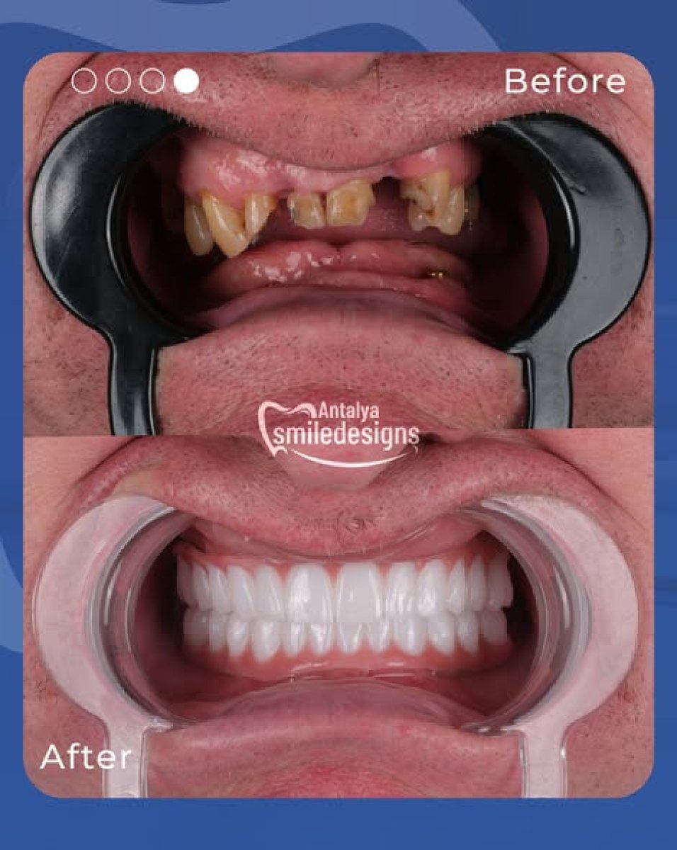Résultats avant et après couronnes métal-céramique chez Antalya Smile Designs, restauration complète du sourire