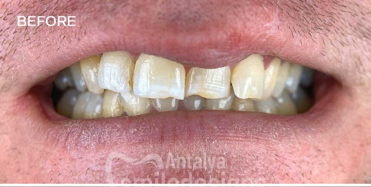 До процедуры Hollywood Smile в Antalya Smile Designs – кривые, сколотые, потемневшие зубы
