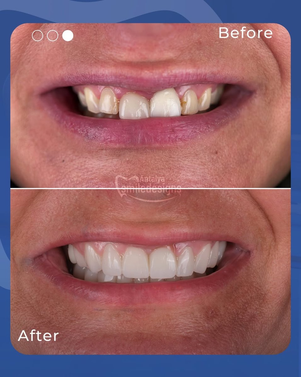 Résultats avant/après Hollywood Smile chez Antalya Smile Designs – transformation par facettes
