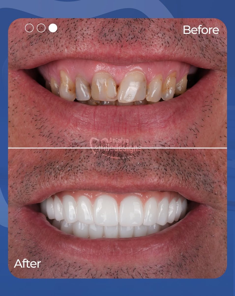 نتيجة قبل وبعد الفينير في Antalya Smile Designs – تحول الابتسامة بالفينير